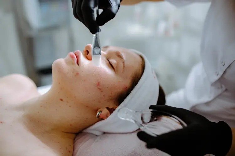 Acne and Pimples